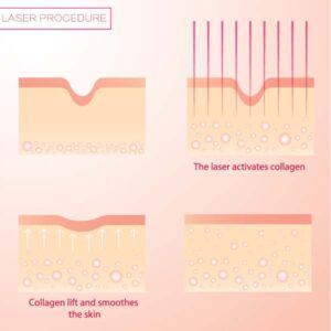 Fractional CO2 Laser Treatments | Lexington, KY